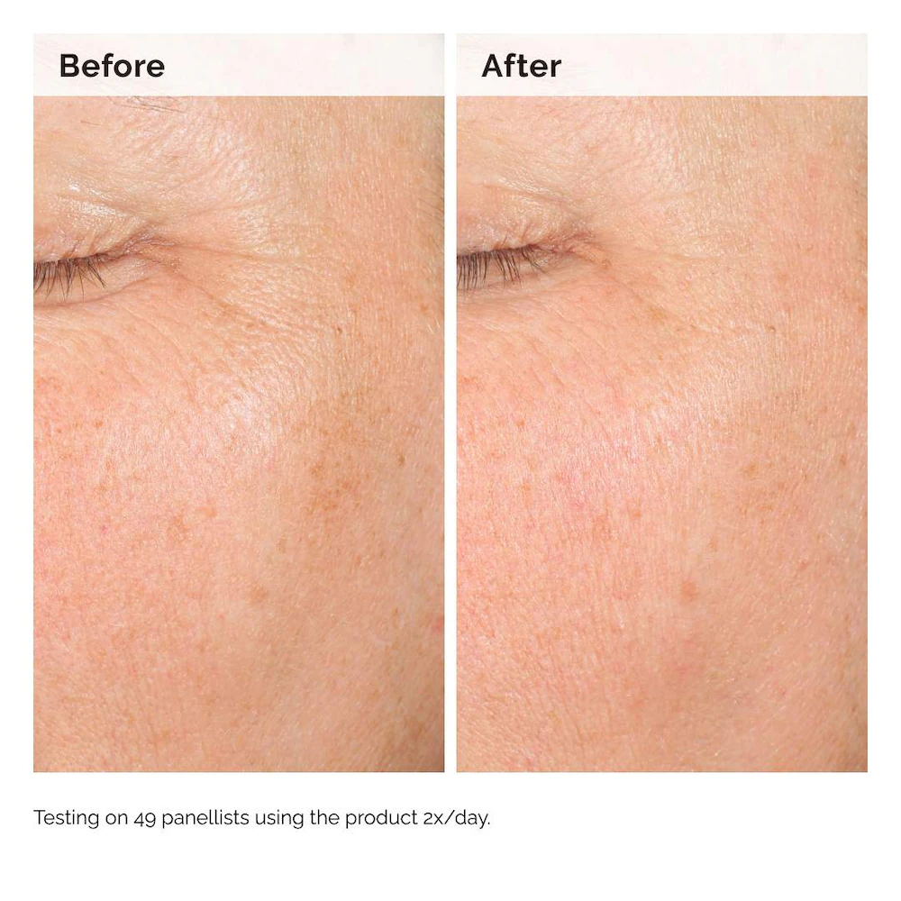 Hyaluronic Acid for Hyperpigmentation - Image 6